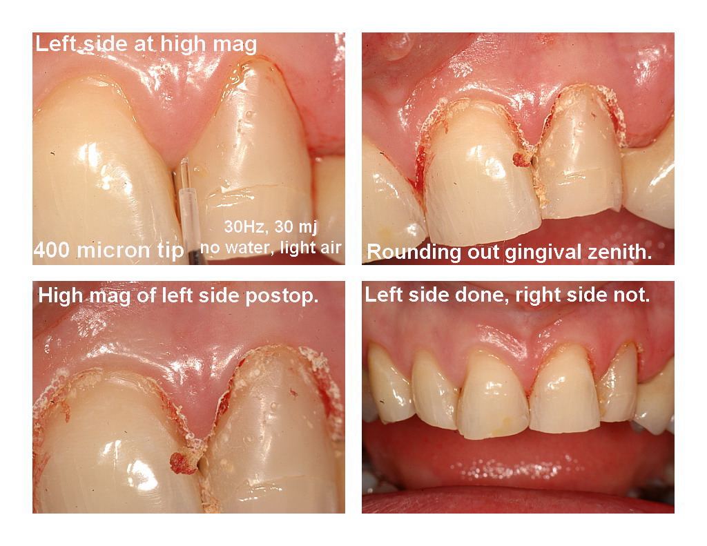 Veneers and recontouring pg2.jpg